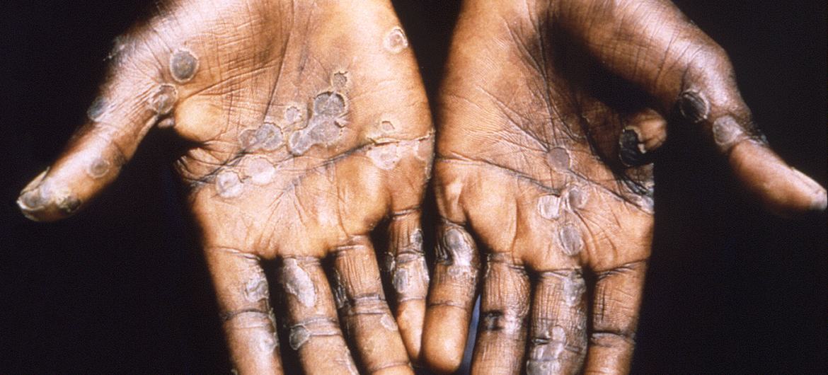 Santé : 9 cas suspects de variole du singe signalés en Guinée